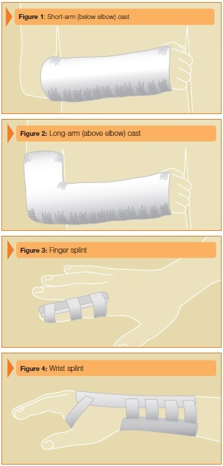 Difference between Cast and Splint